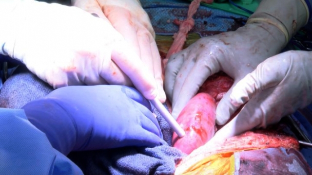 Realizan el primer trasplante de riñones de cerdo a un paciente con muerte cerebral