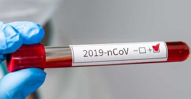 Una persona murió y 75 fueron diagnosticadas hoy con coronavirus en Argentina